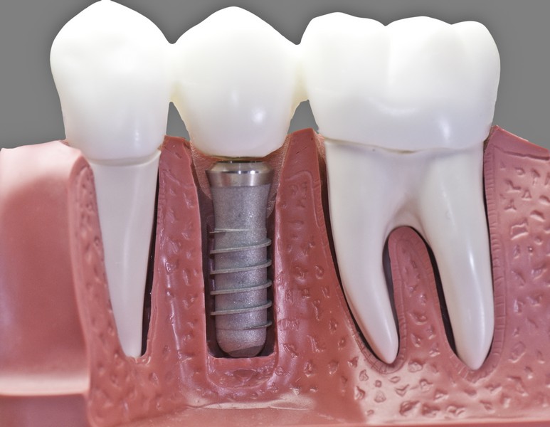 רשלנות בניתוח השתלת שיניים